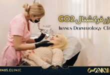 لیزر فرکشنال CO2