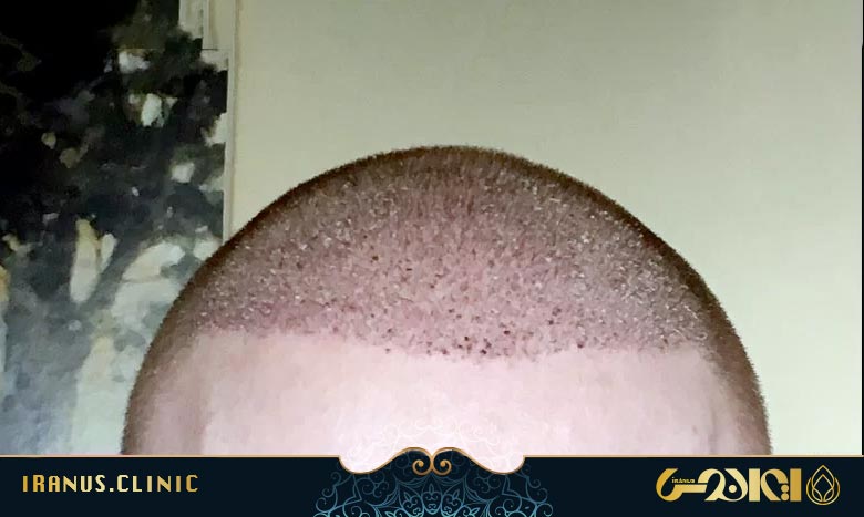 پوسته سر بعد از کاشت مو