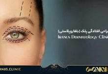 بلفاروپلاستی
