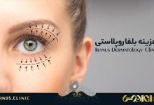 هزینه بلفاروپلاستی