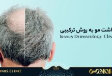 کاشت مو به روش ترکیبی