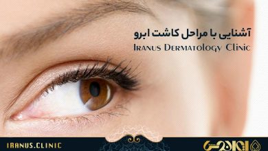 آشنایی با مراحل کاشت ابرو