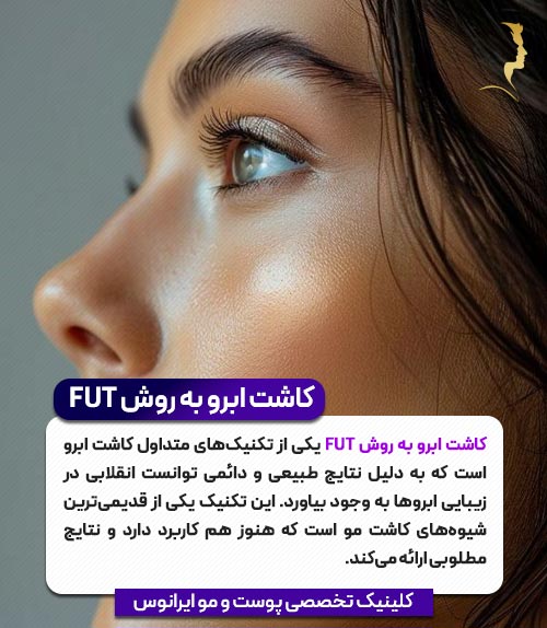 کاشت ابرو به روش FUT