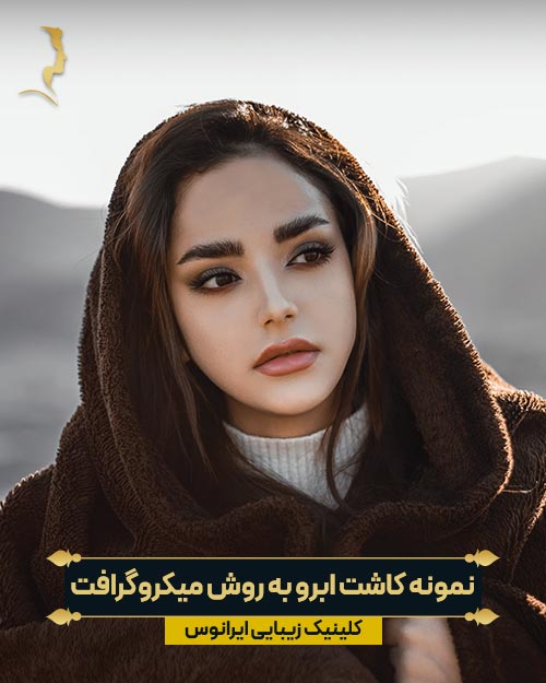 کاشت ابرو به روش میکروگرافت