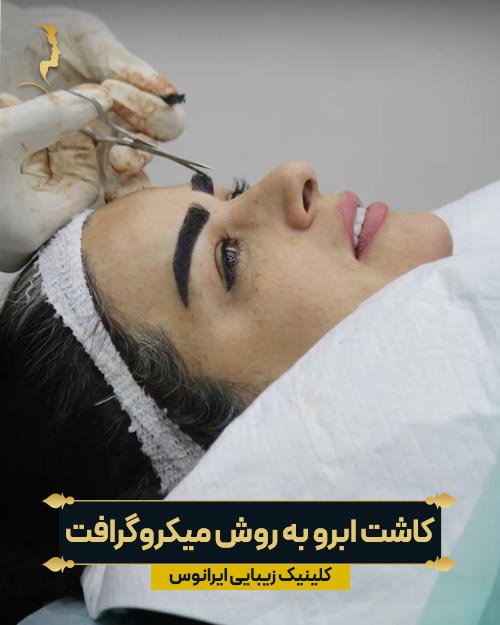 مرحله کاشت گرافت ها در روش میکروگرافت