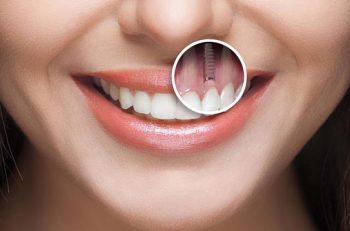 قبل و بعد از ایمپلنت دندان